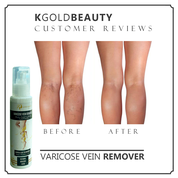 VARICOSE VEIN REMOVER 2PC. 999 AND 2PCS SCAR SERUM 1500 W/FREE SOAP